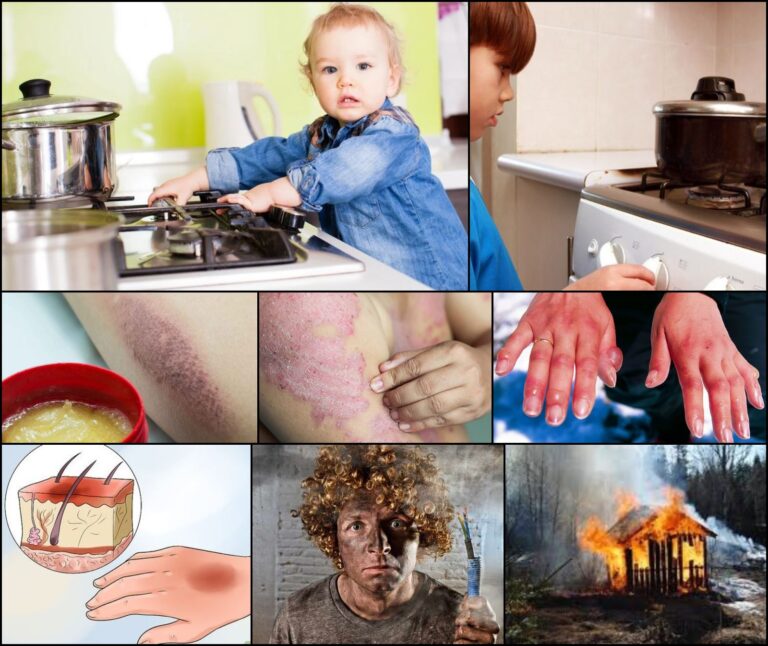 Yanık Tedavisi 171120220727-N1