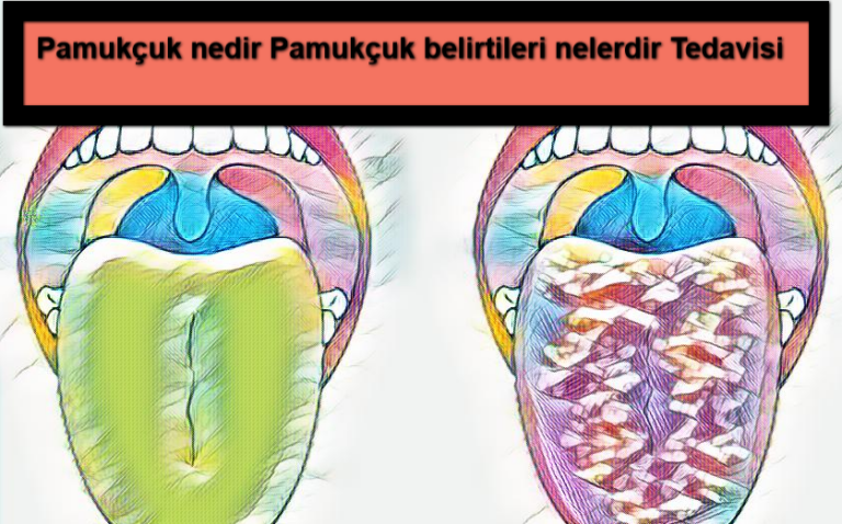 Pamukçuk nedir Pamukçuk belirtileri nelerdir Tedavisi